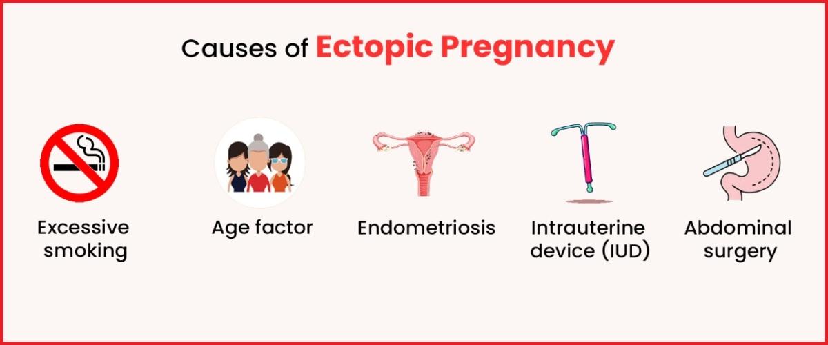 Causes of Ectopic Pregnancy